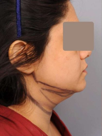 Neck Liposuction / Chin Liposuction Before & After Patient #1893