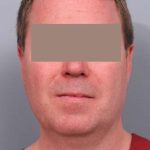 Neck Liposuction / Chin Liposuction Before & After Patient #1900