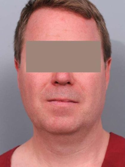 Neck Liposuction / Chin Liposuction Before & After Patient #1900