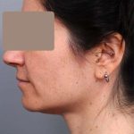 Neck Liposuction / Chin Liposuction Before & After Patient #1913