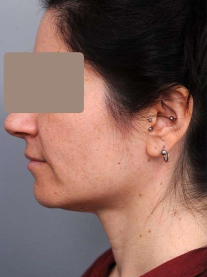 Neck Liposuction / Chin Liposuction Before & After Patient #1913