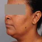 Neck Liposuction / Chin Liposuction Before & After Patient #1930