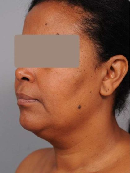 Neck Liposuction / Chin Liposuction Before & After Patient #1930