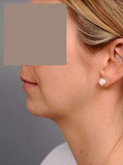 Neck Liposuction / Chin Liposuction Before & After Patient #1937