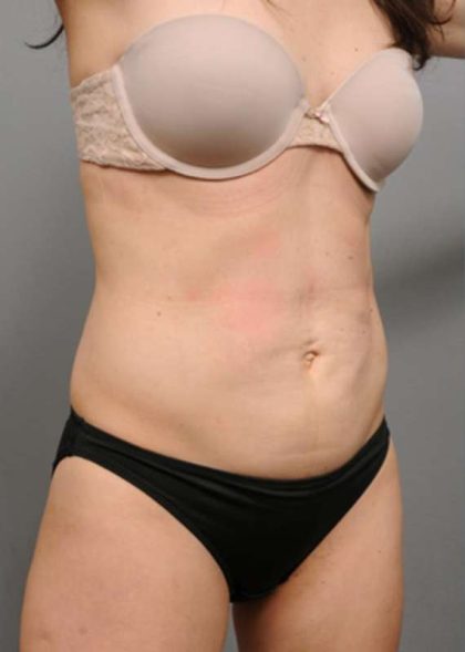Tummy Tuck Before & After Patient #354