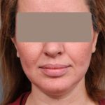 Neck Liposuction / Chin Liposuction Before & After Patient #1946