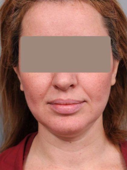 Neck Liposuction / Chin Liposuction Before & After Patient #1946