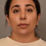 Neck Liposuction / Chin Liposuction Before & After Patient #1953