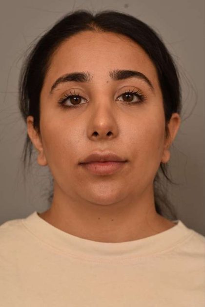 Neck Liposuction / Chin Liposuction Before & After Patient #1953