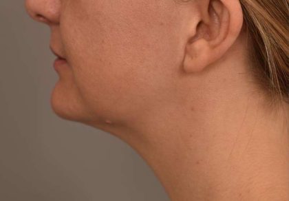 Neck Liposuction / Chin Liposuction Before & After Patient #1967