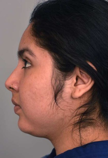 Neck Liposuction / Chin Liposuction Before & After Patient #1990