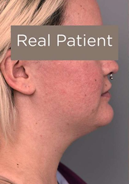 Neck Liposuction / Chin Liposuction Before & After Patient #2002