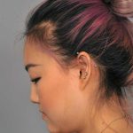 Neck Liposuction / Chin Liposuction Before & After Patient #2011