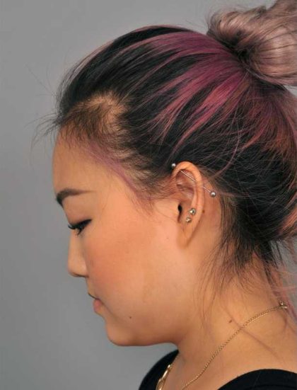 Neck Liposuction / Chin Liposuction Before & After Patient #2011
