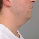Neck Liposuction / Chin Liposuction Before & After Patient #2027