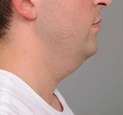 Neck Liposuction / Chin Liposuction Before & After Patient #2027
