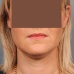 Neck Liposuction / Chin Liposuction Before & After Patient #2034