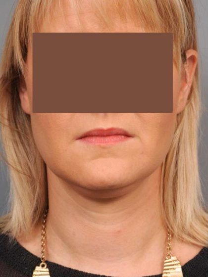 Neck Liposuction / Chin Liposuction Before & After Patient #2034