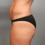 Tummy Tuck Before & After Patient #363