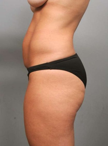 Tummy Tuck Before & After Patient #363