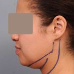 Neck Liposuction / Chin Liposuction Before & After Patient #2046