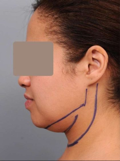 Neck Liposuction / Chin Liposuction Before & After Patient #2046