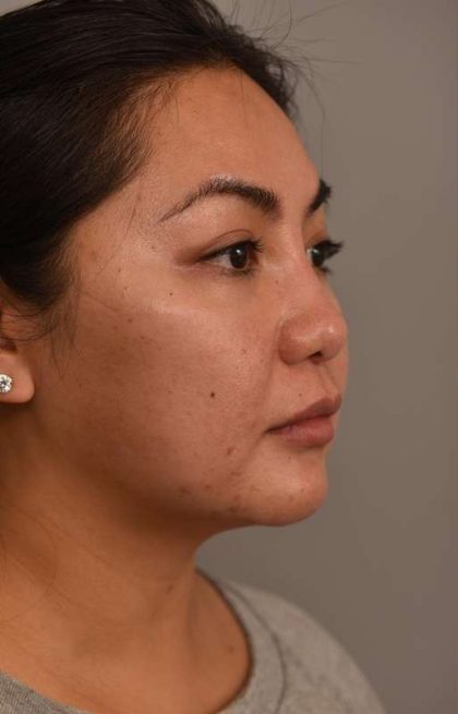 Buccal Fat Removal Before & After Patient #2063
