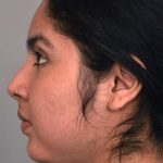 Buccal Fat Removal Before & After Patient #2099