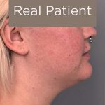 Buccal Fat Removal Before & After Patient #2108