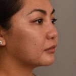 Cheek Liposuction Before & After Patient #2136