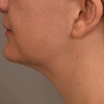 Cheek Liposuction Before & After Patient #2165