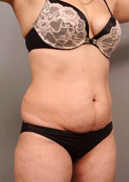 Tummy Tuck Before & After Patient #370