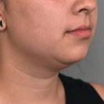 Cheek Liposuction Before & After Patient #2197