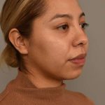 Chin Implant Before & After Patient #2210