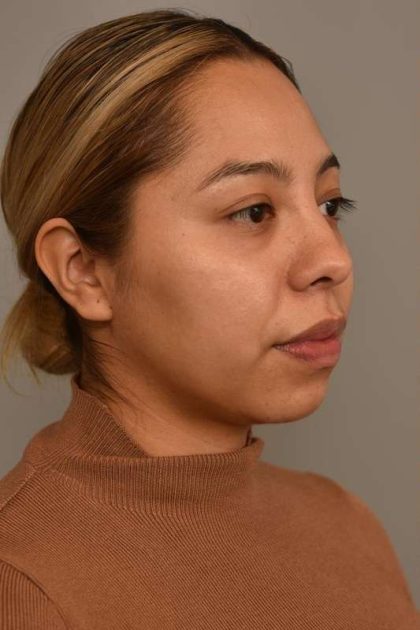 Chin Implant Before & After Patient #2210