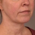 Chin Implant Before & After Patient #2220