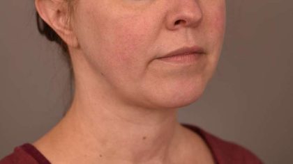 Chin Implant Before & After Patient #2220