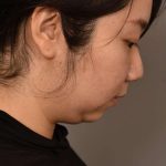 Chin Implant Before & After Patient #2234