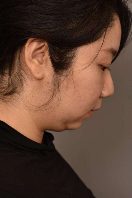 Chin Implant Before & After Patient #2234