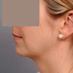 Chin Implant Before & After Patient #2253