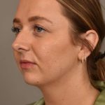 Chin Implant Before & After Patient #2262