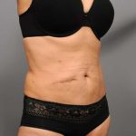 Tummy Tuck Before & After Patient #377