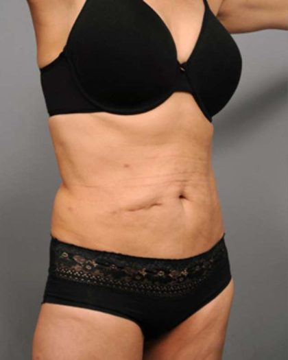 Tummy Tuck Before & After Patient #377