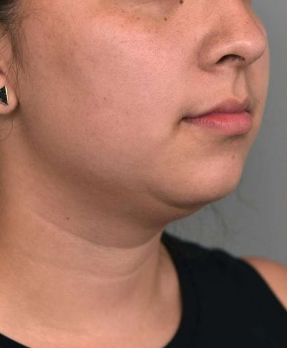 Chin Implant Before & After Patient #2278
