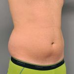 Liposuction For Men Before & After Patient #2294