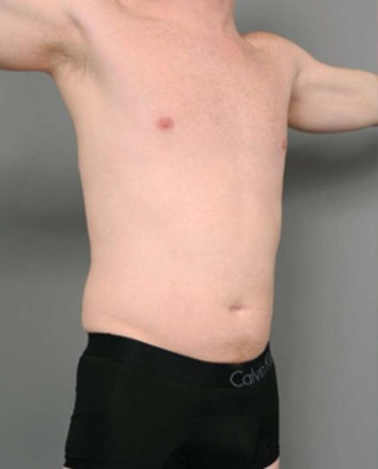 Liposuction For Men Before & After Patient #2301