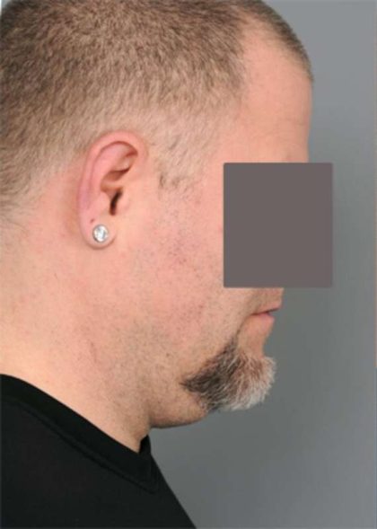 Liposuction For Men Before & After Patient #2308