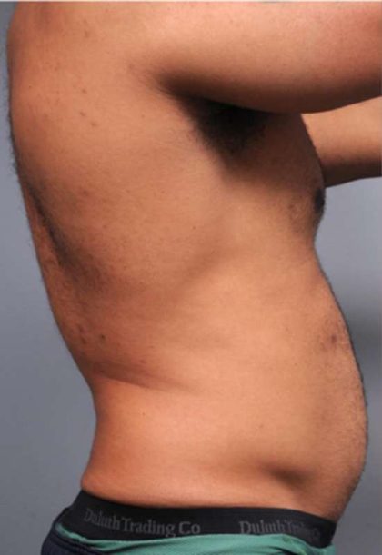 Liposuction For Men Before & After Patient #2315