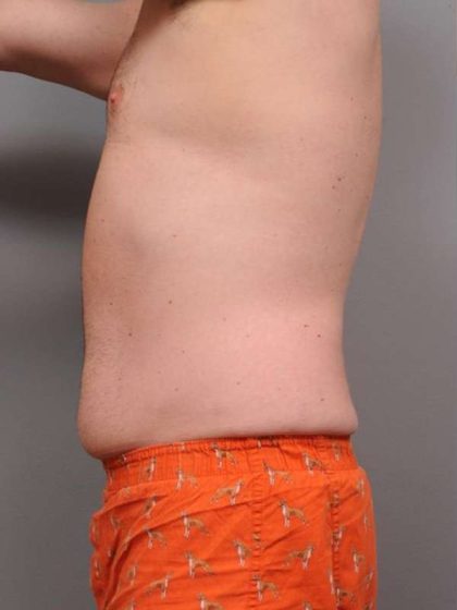 Liposuction For Men Before & After Patient #2337