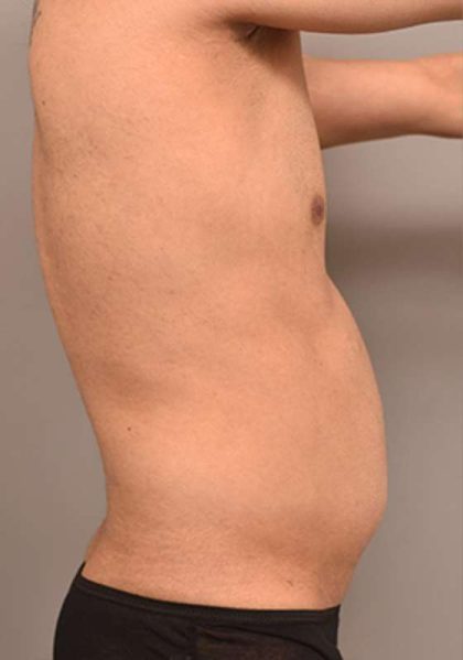 Liposuction For Men Before & After Patient #2358